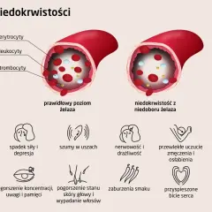 Porównanie prawidłowego poziomu żelaza we krwi z niedoborem, który powoduje anemię i objawy jak bladość, zmęczenie, bóle głowy.
