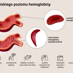 Niski poziom hemoglobiny powoduje, że erytrocyty przybierają sierpowaty kształt, co objawia się bólem głowy, bladością i zmęczeniem.