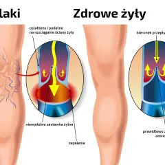 Porównanie nóg z żylakami i zdrowych żył. Pokazuje osłabione ściany żył i niewydolne zastawki, które powodują żylaki.