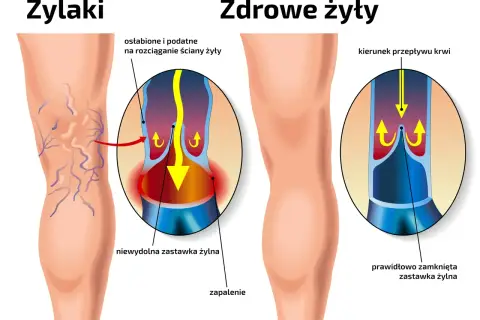 Porównanie nóg z żylakami i zdrowych żył. Pokazuje osłabione ściany żył i niewydolne zastawki, które powodują żylaki.