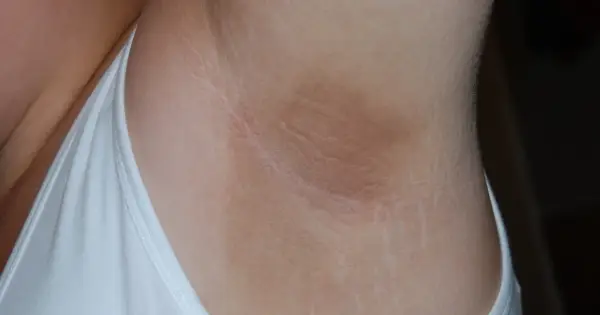 Zmiany skórne pod pachami, które mogą być związane z cukrzycą, widoczne na skórze.