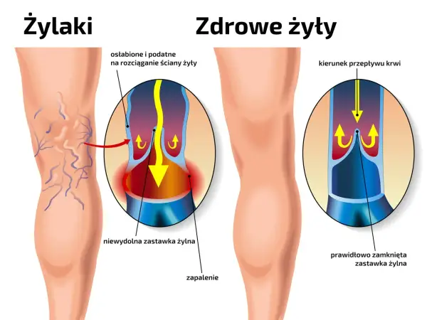 Porównanie nóg z żylakami i zdrowych żył. Pokazuje osłabione ściany żył i niewydolne zastawki, które powodują żylaki.